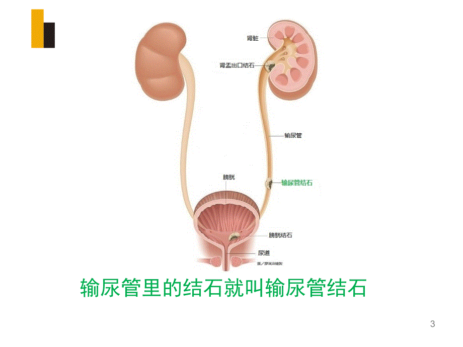 输尿管镜钬激光碎石宣教ppt课件_第3页