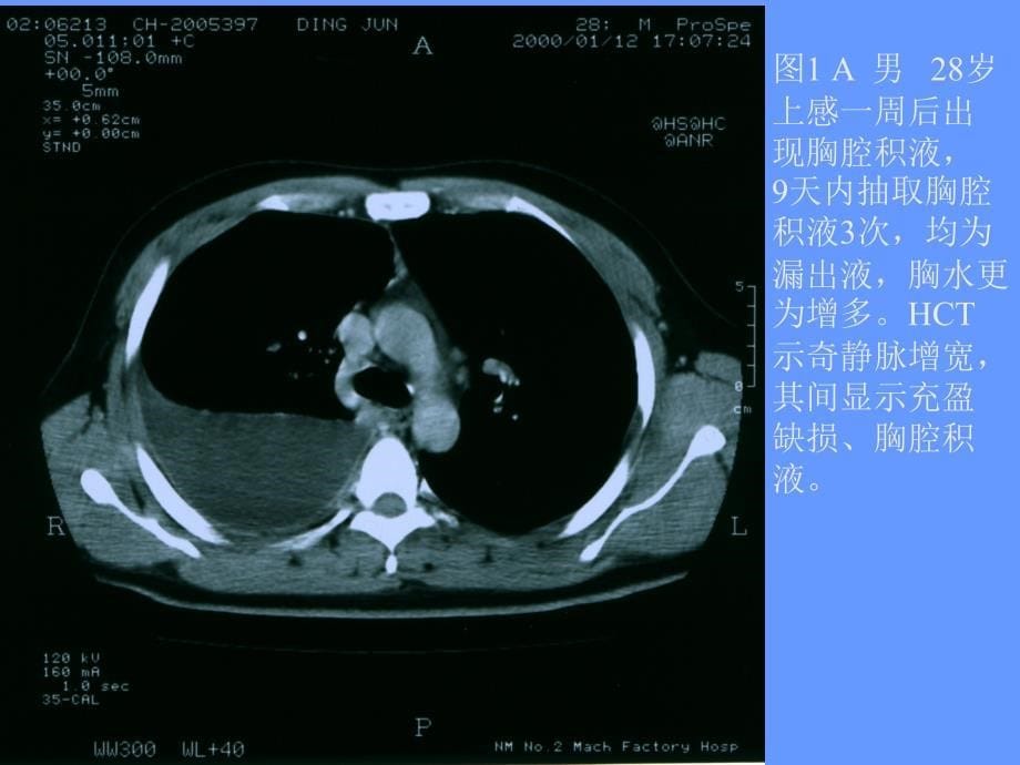 HCT诊断特发性奇静脉血栓_第5页