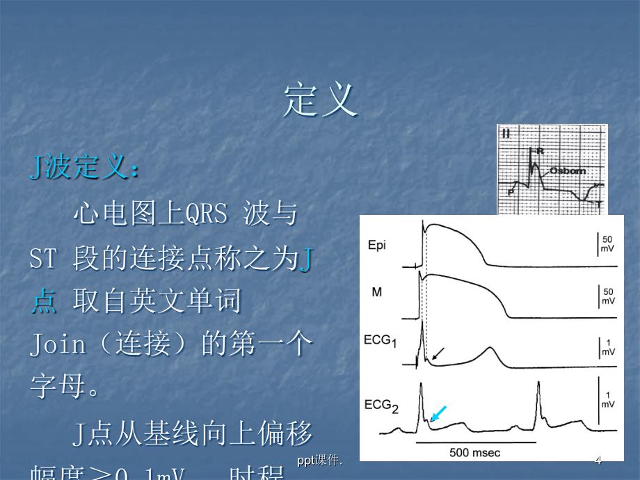 J波与J波综合征ppt课件_第4页