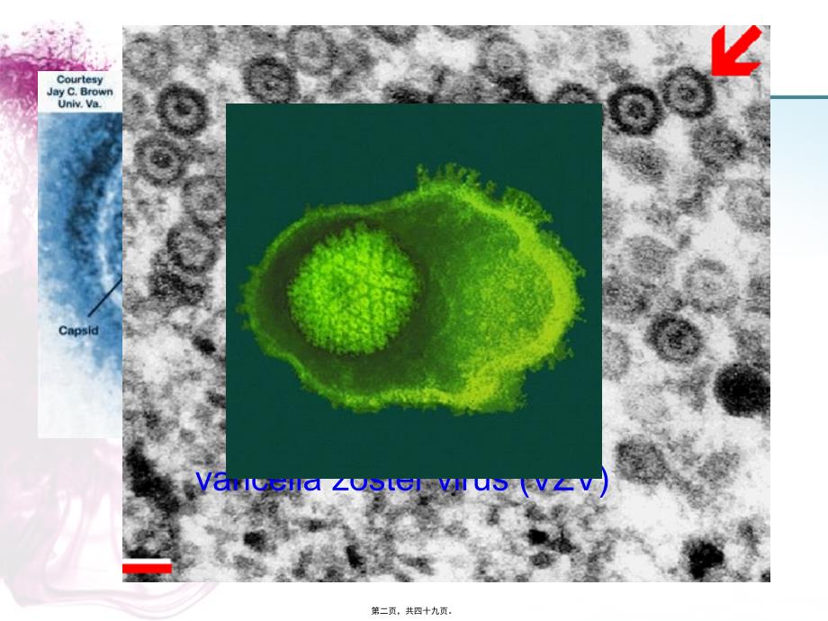 科内讲座-疱疹后疼痛课件_第2页