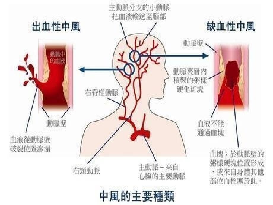 中风后遗症之失语、流涎.PPT_第5页