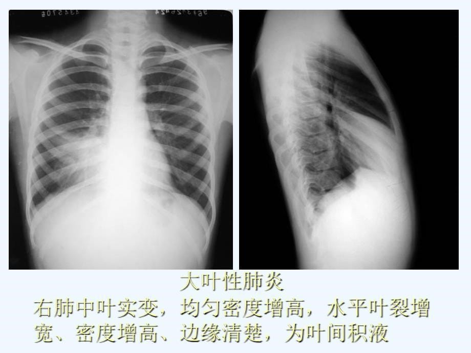 不明原因肺炎讲座简述[001]_第5页