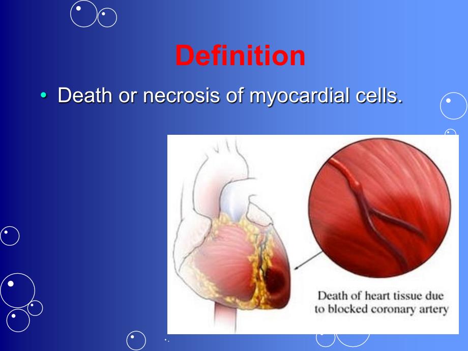 心肌梗死英文ppt课件_第3页