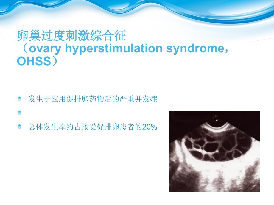 卵巢过度刺激综合征_第2页