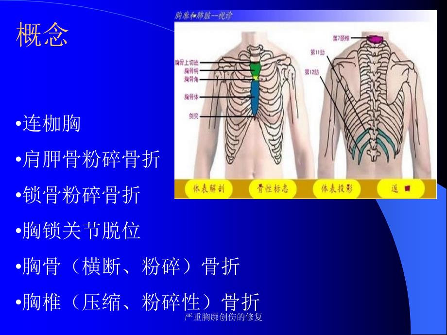 严重胸廓创伤的修复课件_第3页