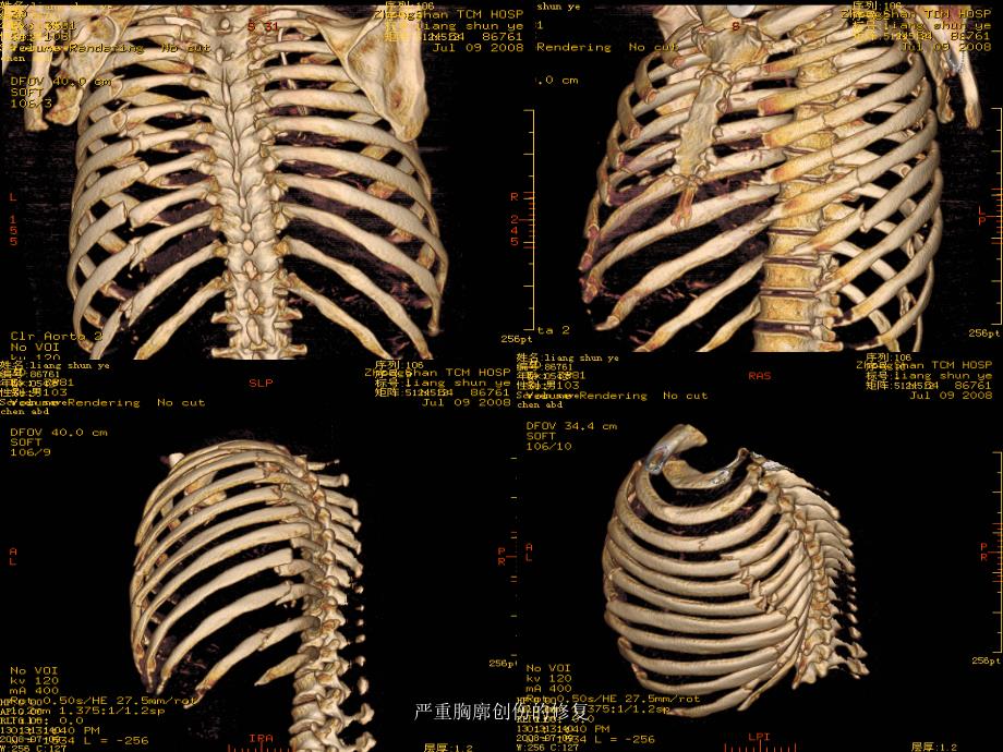 严重胸廓创伤的修复课件_第4页