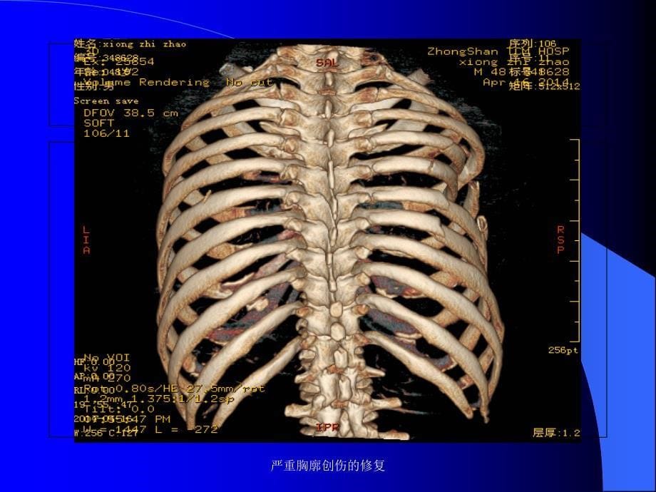 严重胸廓创伤的修复课件_第5页