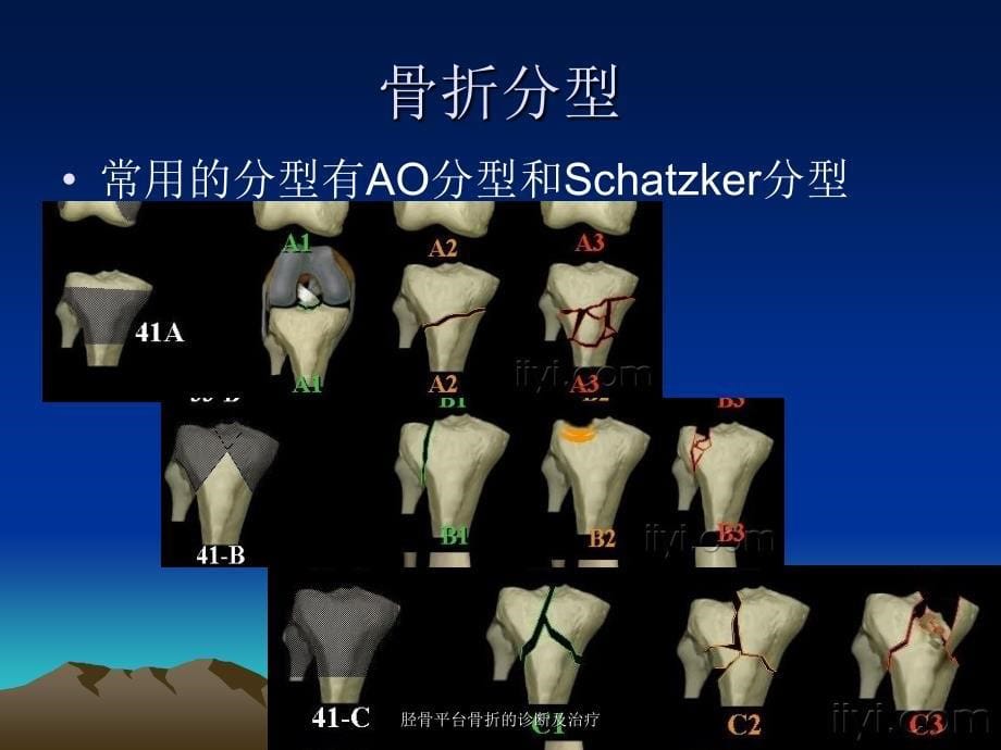 胫骨平台骨折的诊断及治疗课件_第5页