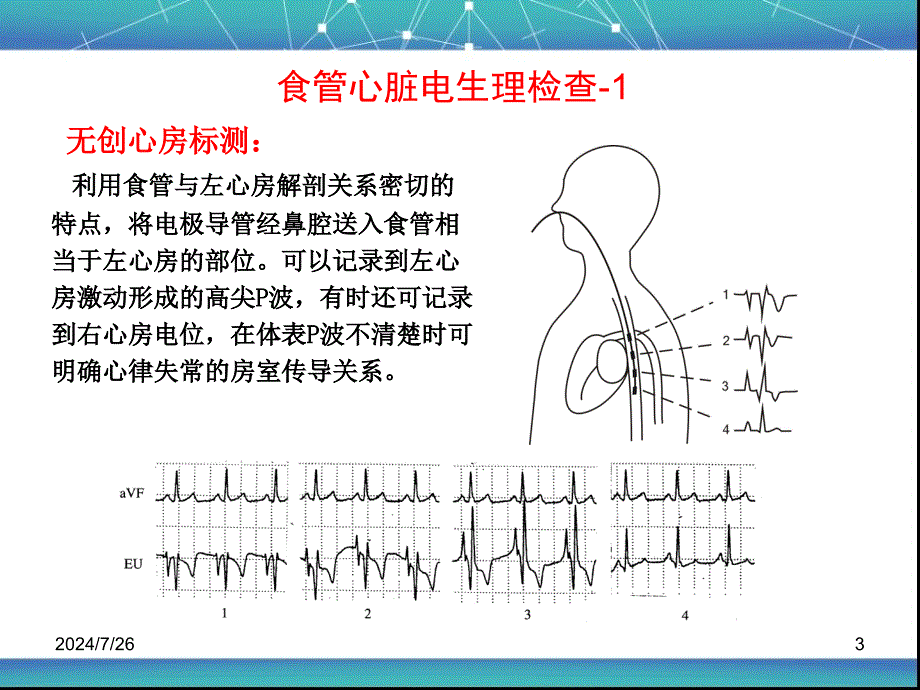 李忠杰如何应用食管心脏电生理诊治心律失常_第3页