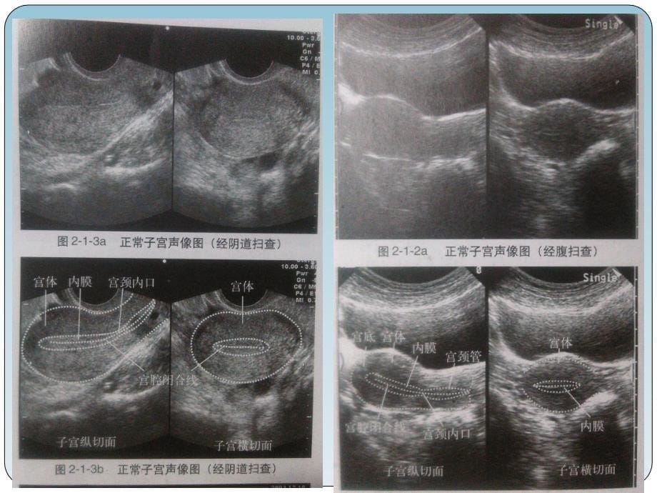 子宫内膜癌子宫粘膜下肌瘤B超表现PPT_第5页