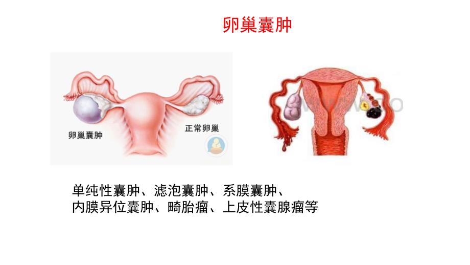 腹腔镜下卵巢囊肿剥除术配合_第4页