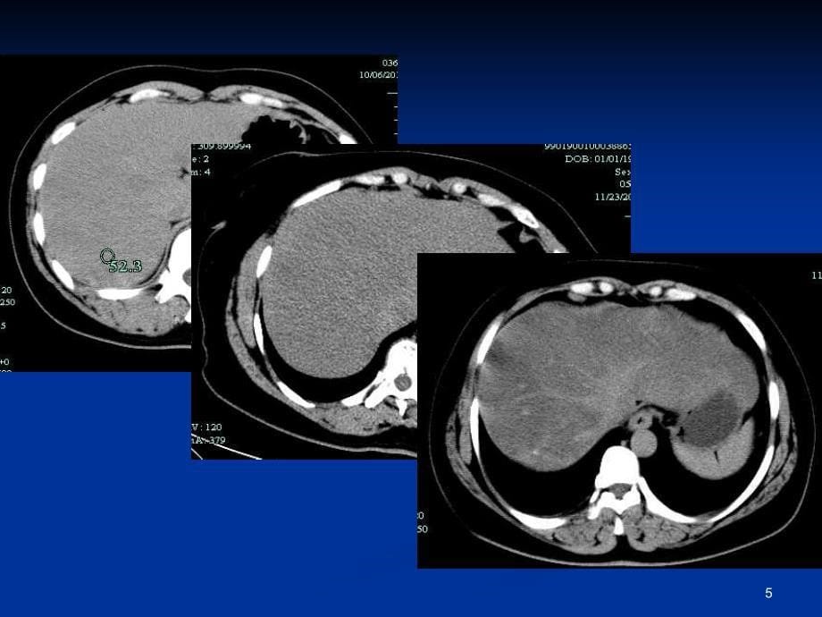 肝脏常见原发肿瘤的CTMRI表现优秀课件_第5页