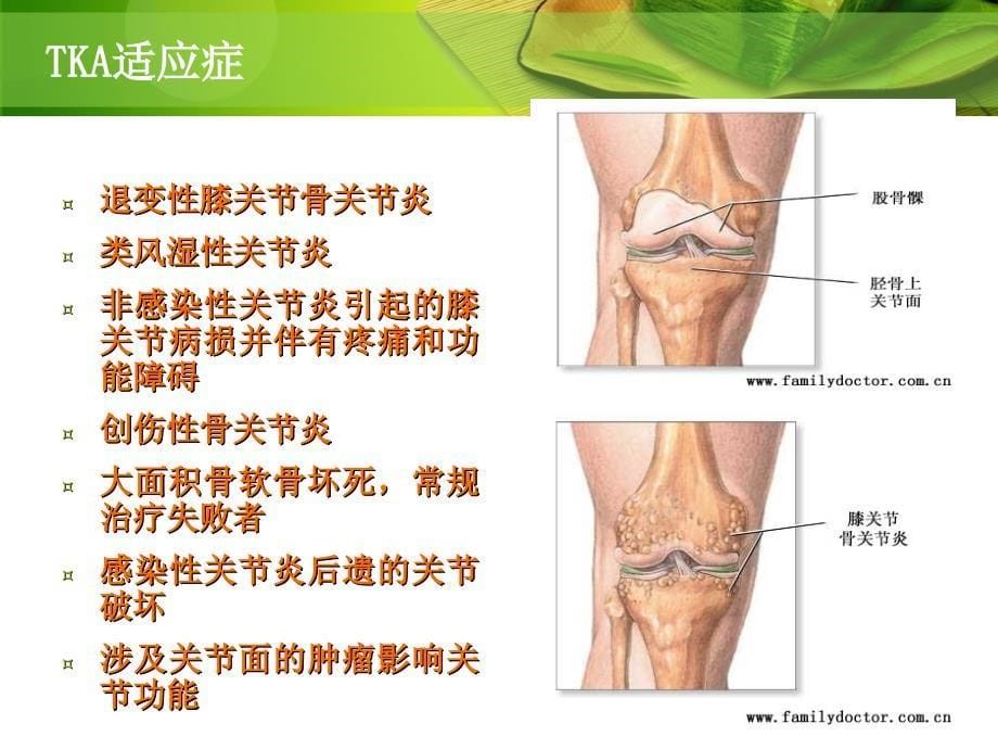 人工全膝关节置换术ppt课件_第5页