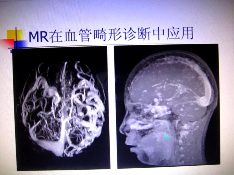 脑血管畸形课件_第5页