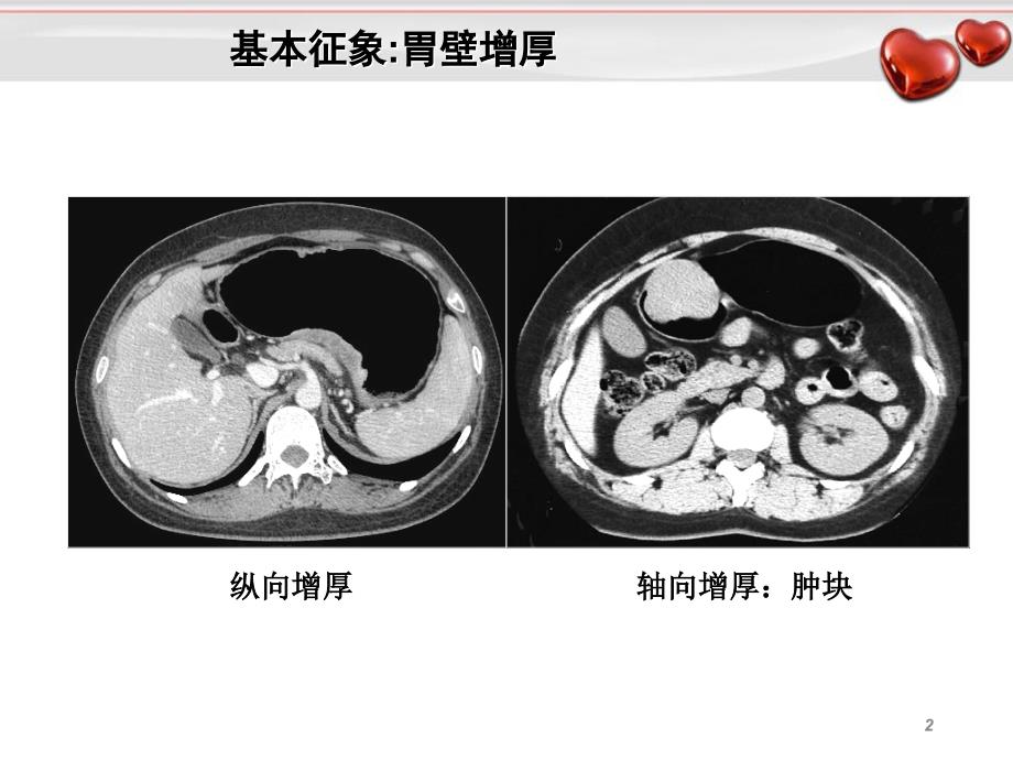 胃癌影像诊断_第2页