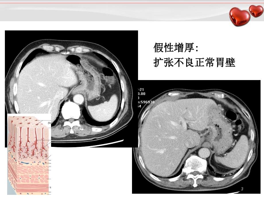 胃癌影像诊断_第3页