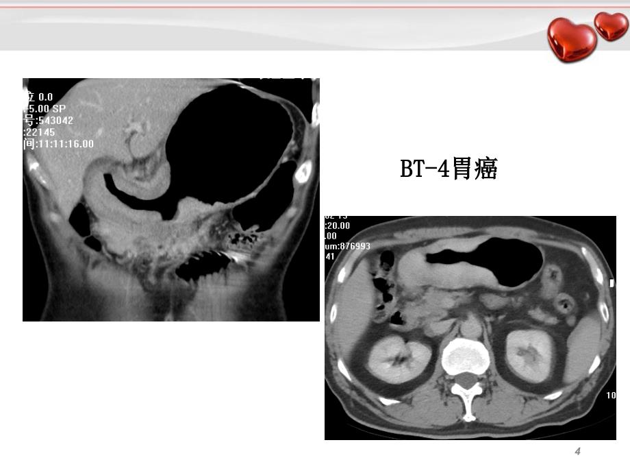 胃癌影像诊断_第4页