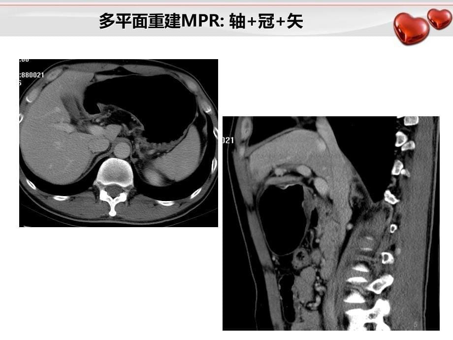 胃癌影像诊断_第5页