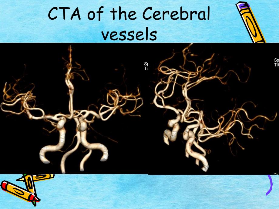 CT临床应用ppt课件_第4页