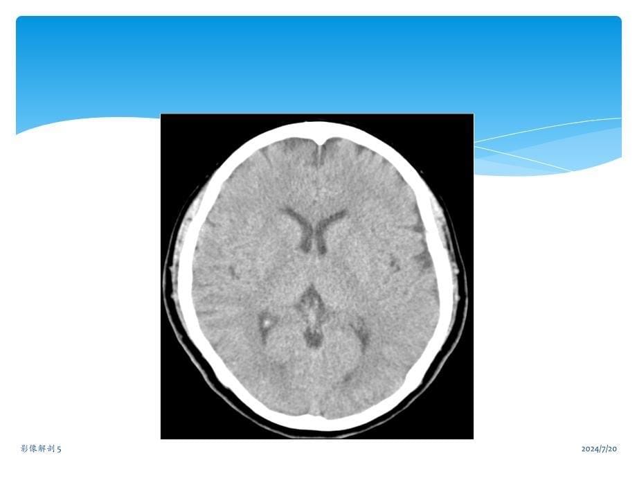 中枢神经系统CT诊断_第5页