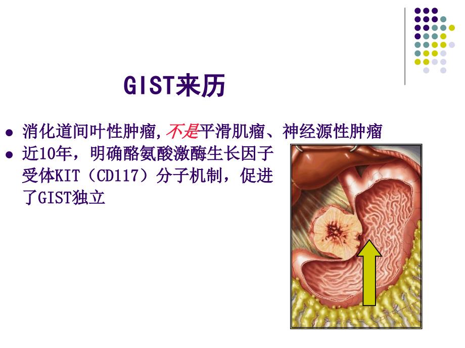 胃肠间质瘤(GIST)_第3页