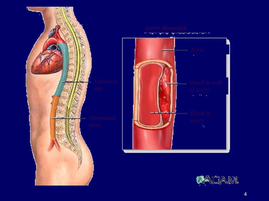 主动脉夹层ppt课件_第4页