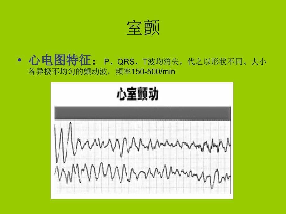 常见恶性心律失常课件.ppt_第5页