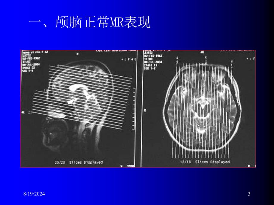 磁共振成像诊断MRI脑部疾病_第3页