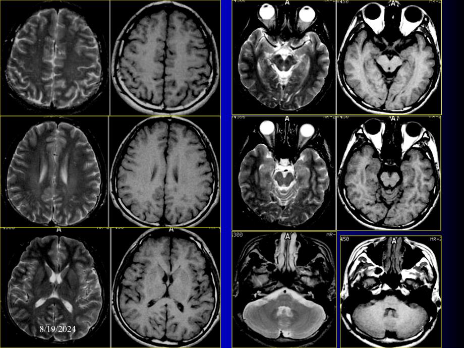 磁共振成像诊断MRI脑部疾病_第4页