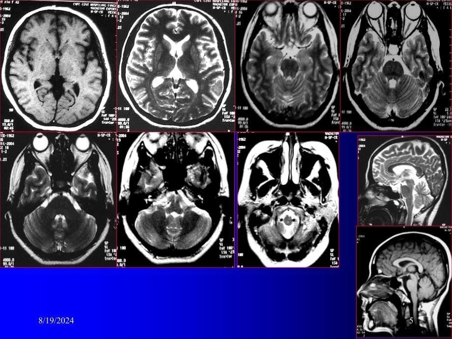 磁共振成像诊断MRI脑部疾病_第5页