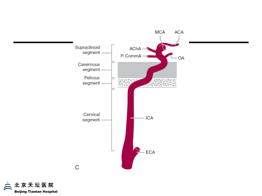 脑血管定位诊断 ppt课件_第4页