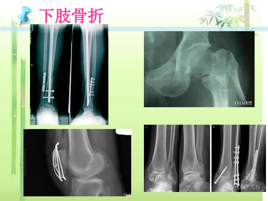 下肢骨折床上康复训练操_第3页