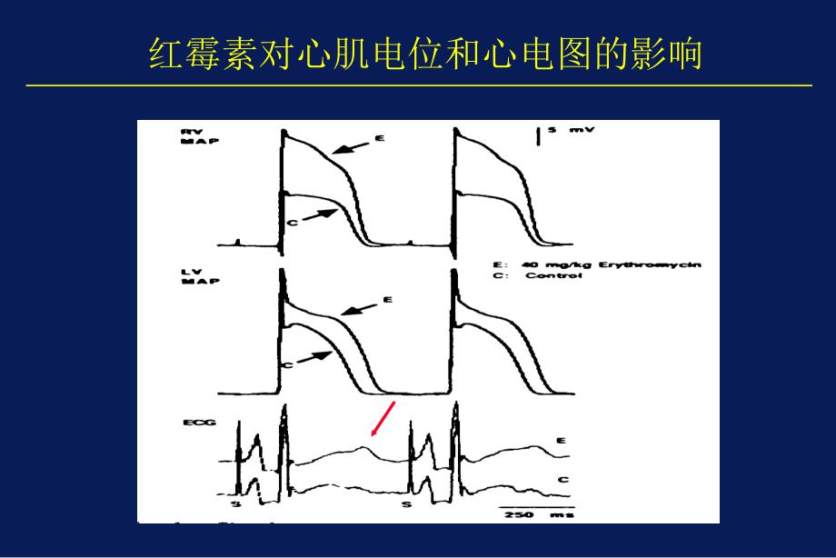 《尖端扭转性室速》PPT课件_第4页