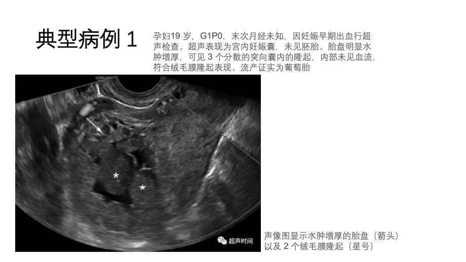 绒毛膜局限性隆起.ppt_第5页