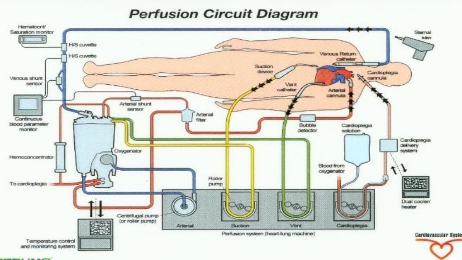 体外循环与心肌保护._第5页