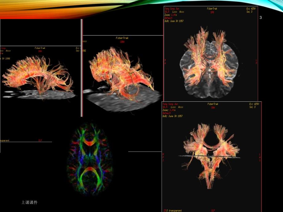 磁共振弥散张量成像讲解#课件参考_第3页