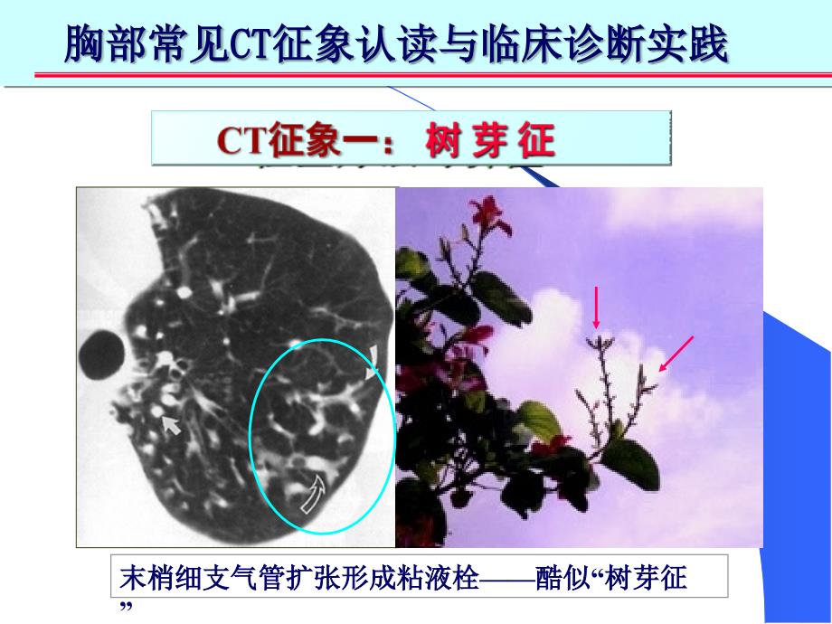 肺部CT-十大入门征象_第4页