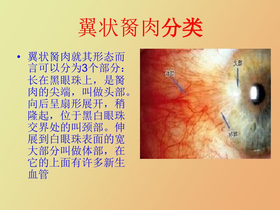 陈科研翼状胬肉_第4页