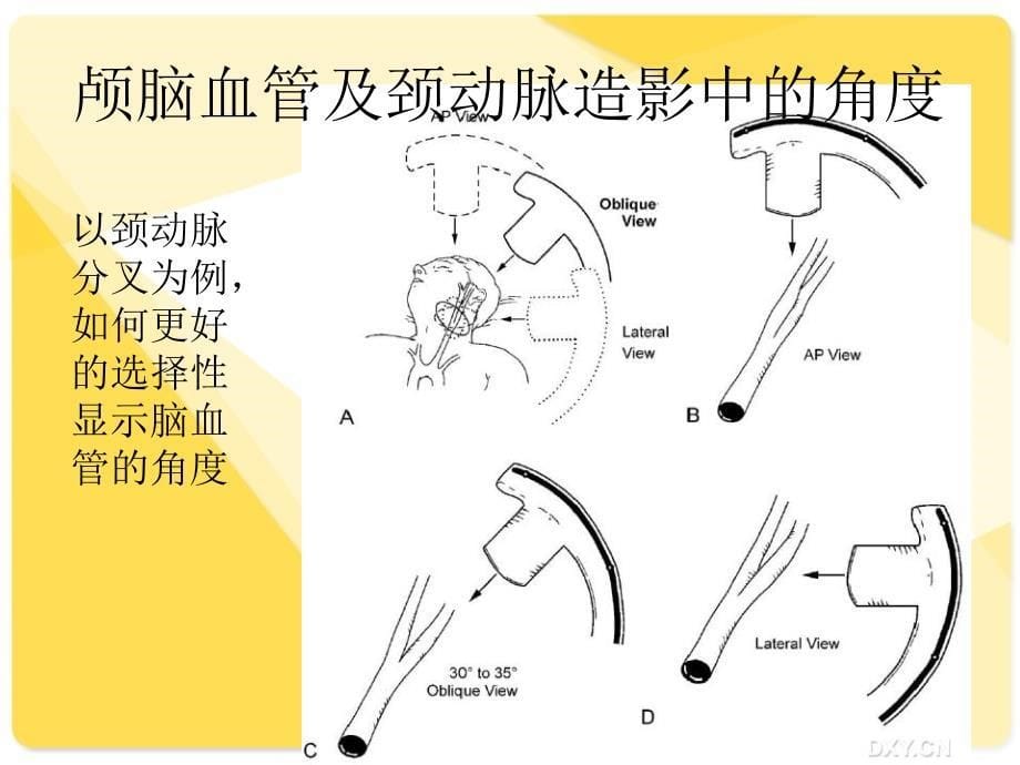 脑血管造影角度选择_第5页