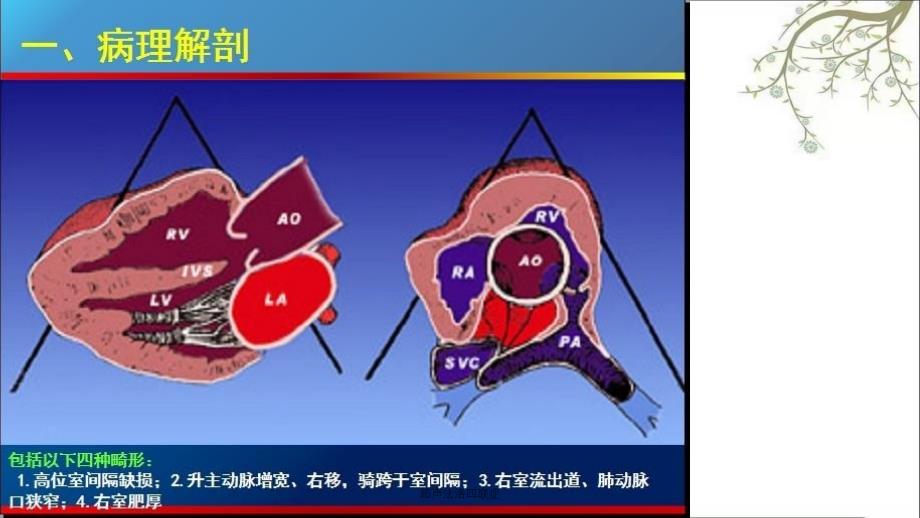 超声法洛四联症课件_第3页