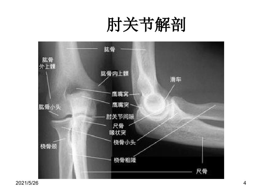 肘关节X线解剖及常见骨折诊断PPT优秀课件_第4页