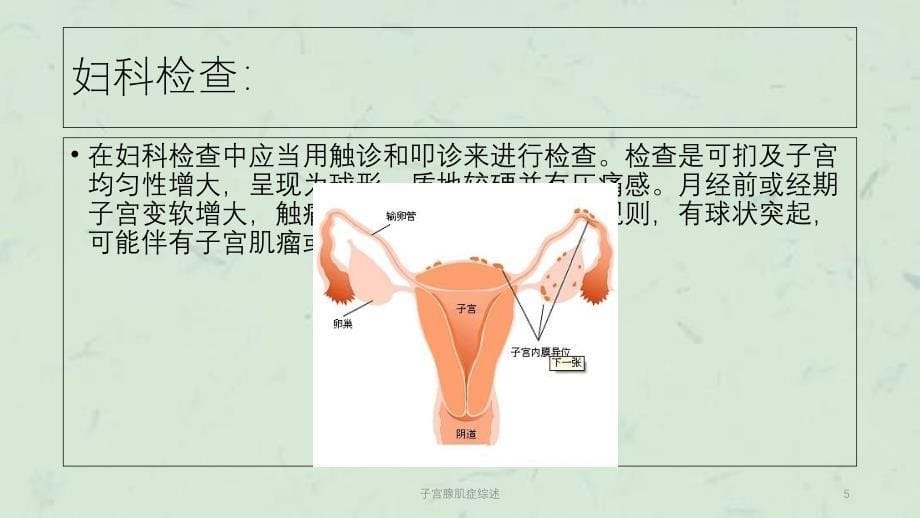 子宫腺肌症综述课件_第5页