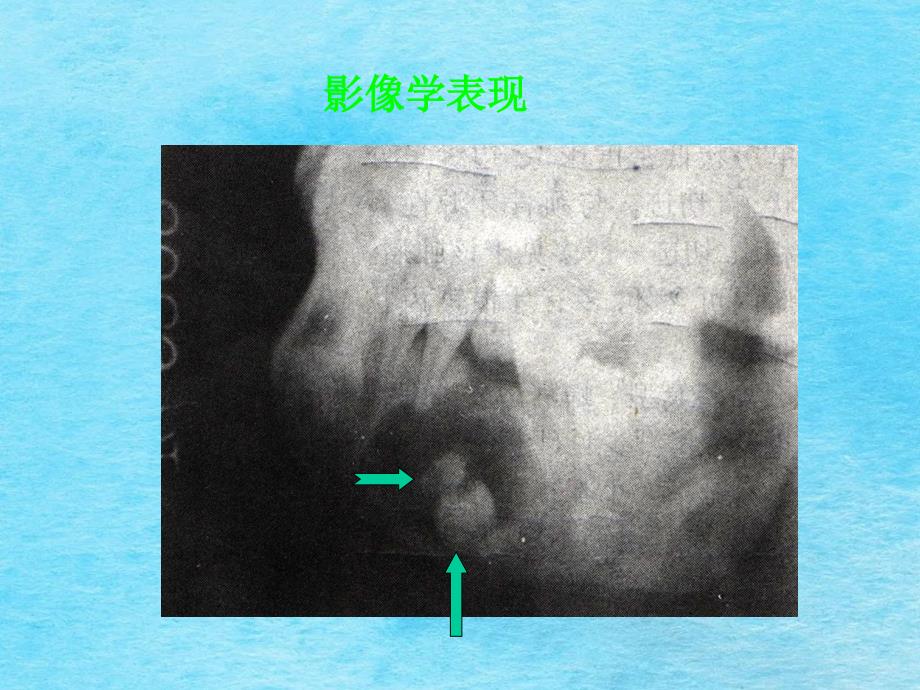 医学牙源性钙化上皮瘤ppt课件_第2页