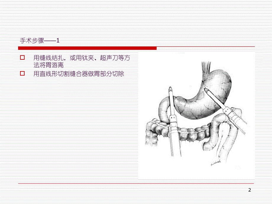 毕II式胃大切ppt课件_第2页