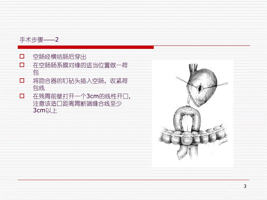 毕II式胃大切ppt课件_第3页