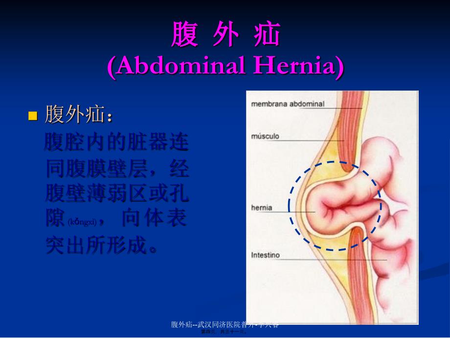 腹外疝--武汉同济医院普外-李兴睿课件_第4页