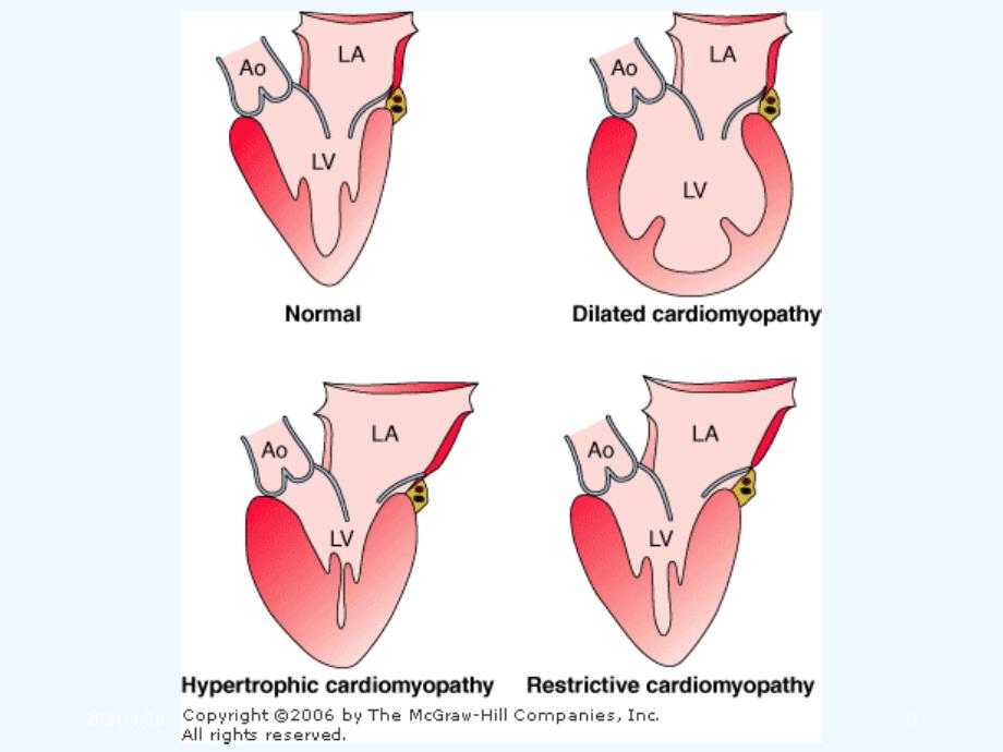 心肌病医学课件_第3页