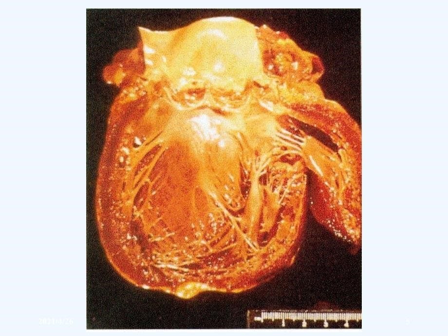 心肌病医学课件_第5页