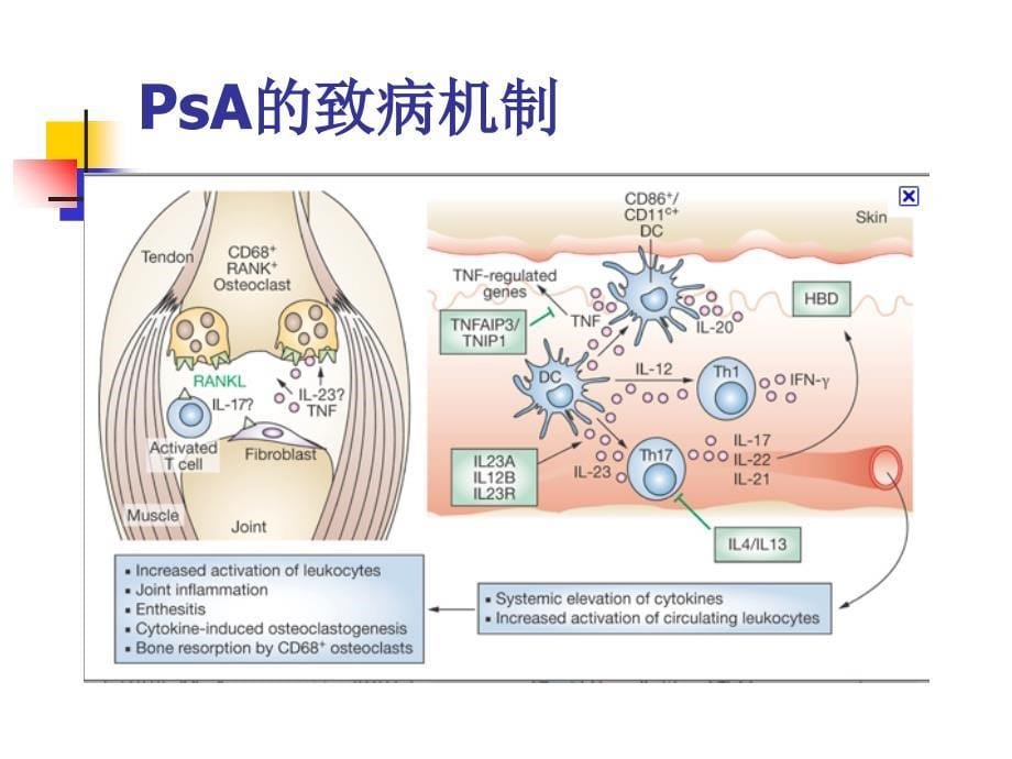 银屑病关节炎诊治指南_第5页