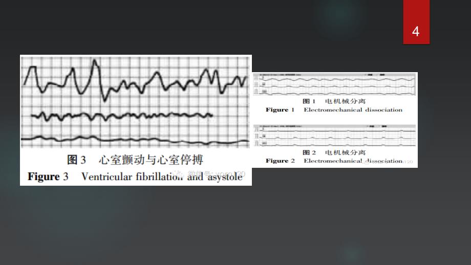 优质课件心电图危急值识别_第4页